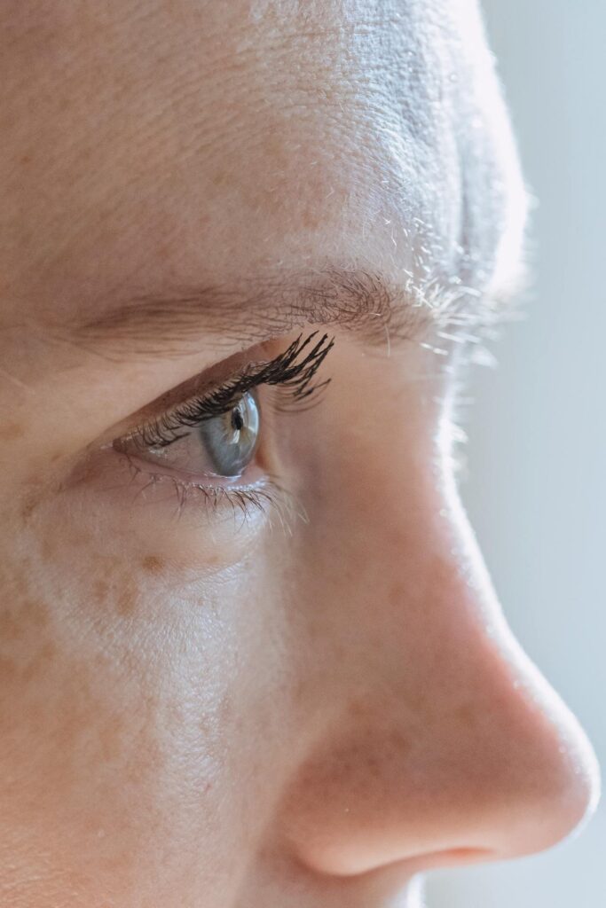 Eine Frau bei der eine Bunny Lines (Nasenfalten) Behandlung mit Botox durchgeführt wurde.