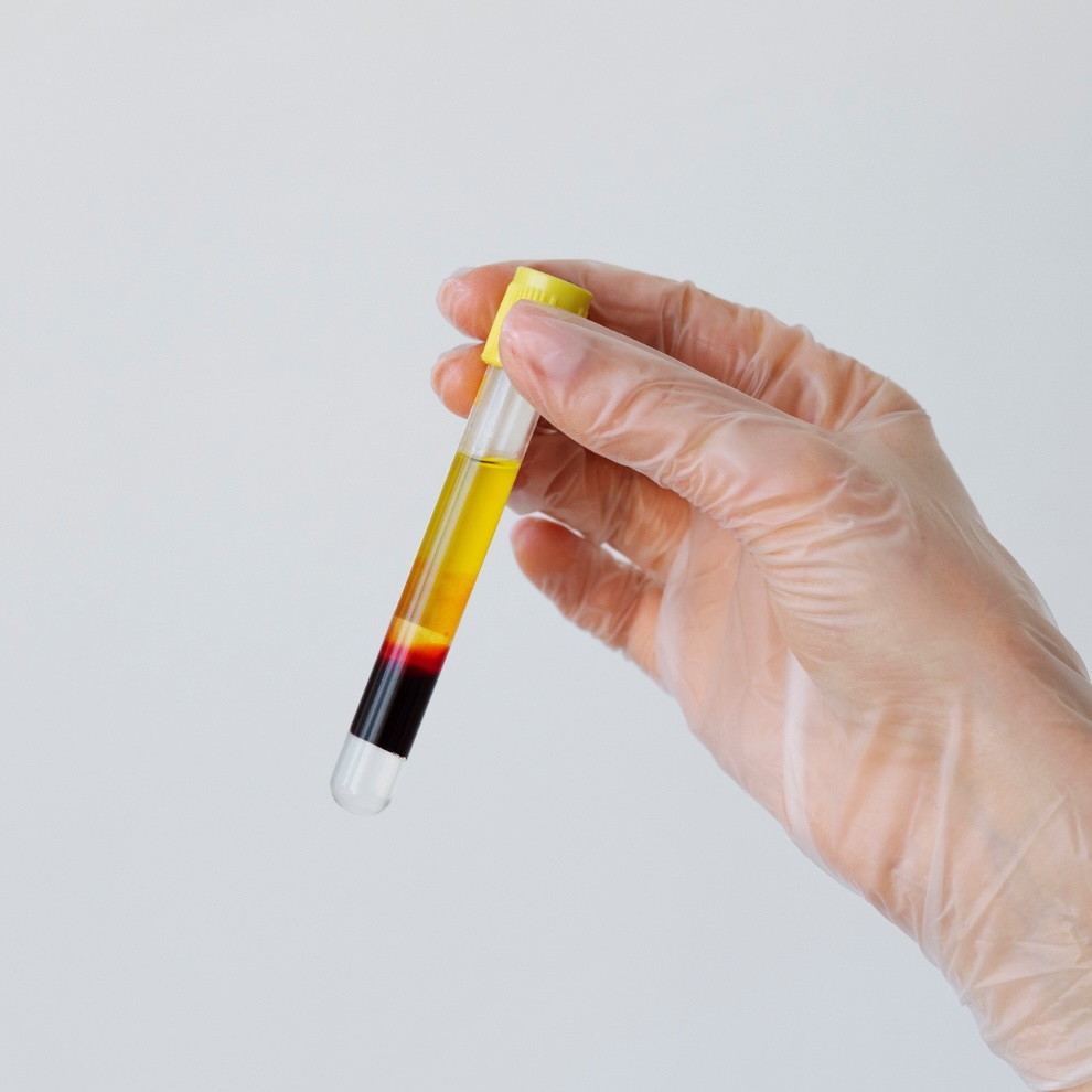 Platelet-Rich-Plasma (PRP) in einem Gefäß.