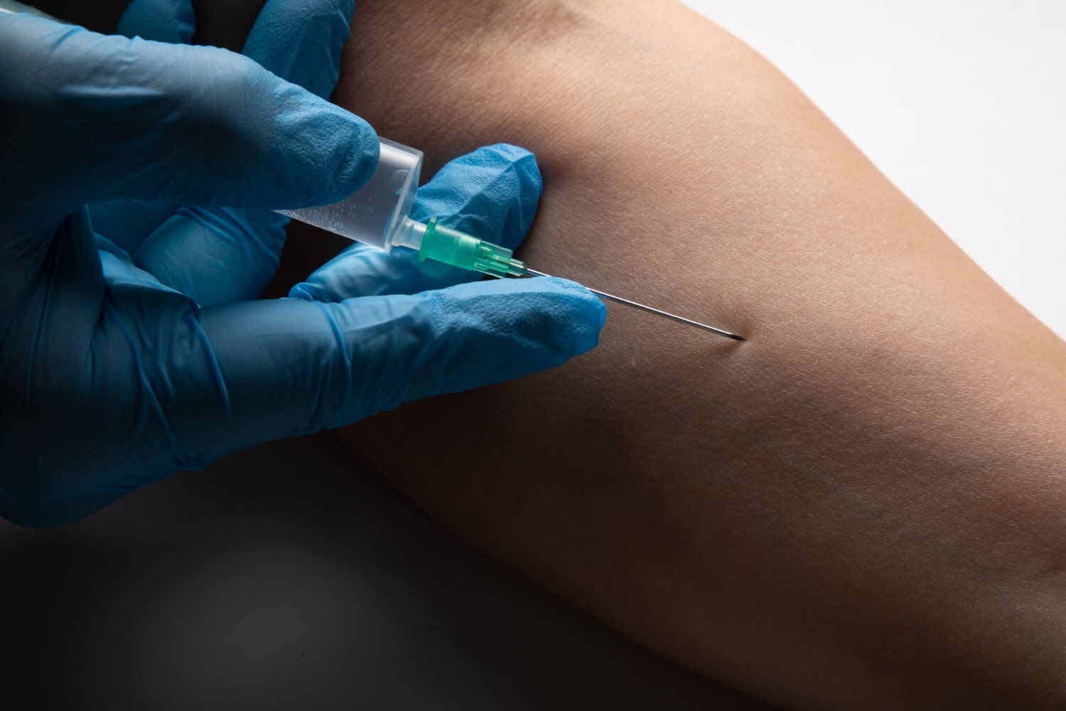 29 Nahaufnahme einer medizinischen Injektion in die Haut mit blauen Handschuhen – symbolisiert die Sklerotherapie zur Behandlung von Besenreisern.