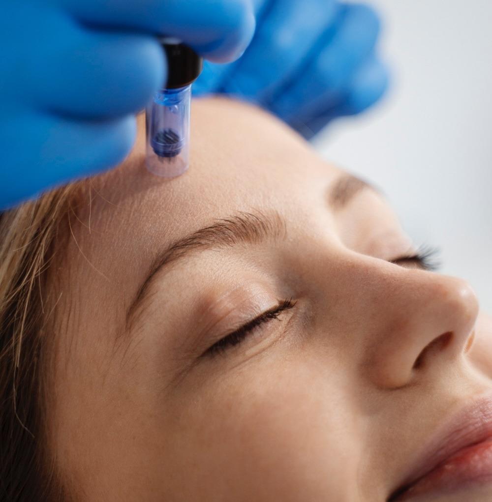 Microneedling
